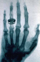 Een van de eerste röntgenfoto's / Bron: Wilhelm Rntgen, Old Moonraker, Wikimedia Commons (Publiek domein)