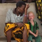 Albino's in Afrika: Hulporganisaties in Nederland
