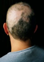 Een patroon van onvolledig haarverlies bij een lijder aan trichotillomanie / Bron: Robodoc (original uploader), Wikimedia Commons (Publiek domein)